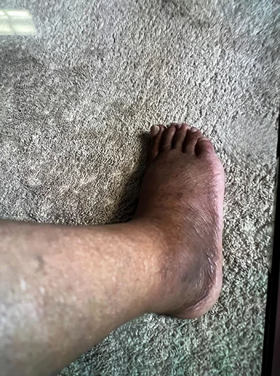 Chronic Pain Chattanooga TN Margie Foot Before